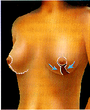 Contoured breast after surgery